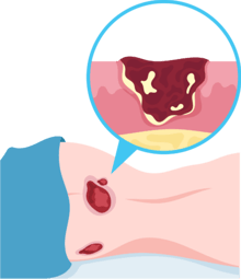 Pressure Injury